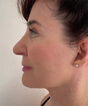 After Image: Facelift - left-side