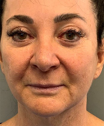 Before Image: Facelift - front