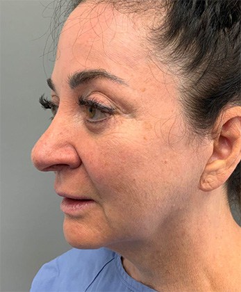 Before Image: Facelift - left-front-oblique
