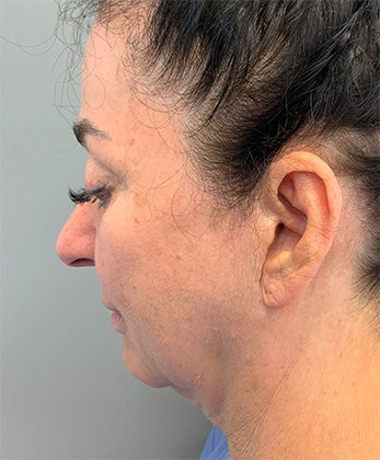 Before Image: Facelift - left-side
