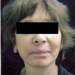 After Image: Facelift - front