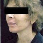 After Image: Facelift - left-front-oblique