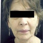 Before Image: Facelift - front
