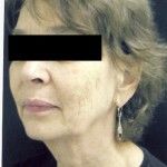 Before Image: Facelift - left-front-oblique