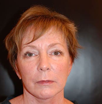 After Image: Facelift - front
