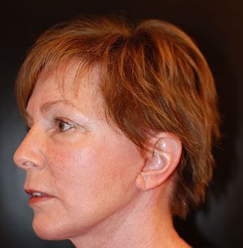 After Image: Facelift - left-front-oblique