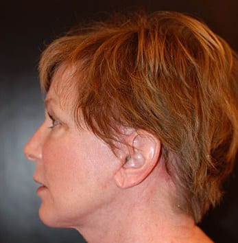 After Image: Facelift - left-side