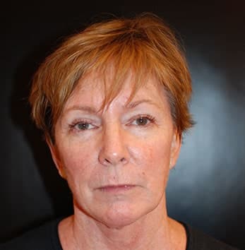 Before Image: Facelift - front