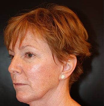 Before Image: Facelift - left-front-oblique