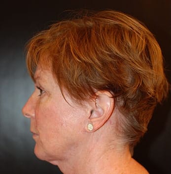 Before Image: Facelift - left-side