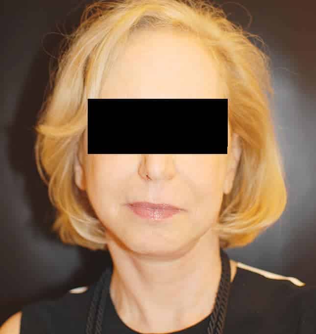 After Image: Facelift - front