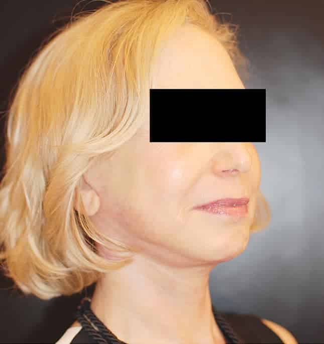 After Image: Facelift - right-front-oblique