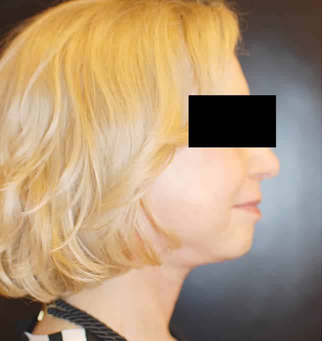 After Image: Facelift - right-side