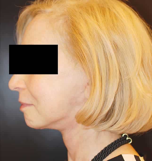 After Image: Facelift - left-side