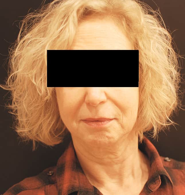 Before Image: Facelift - front