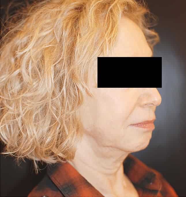 Before Image: Facelift - right-front-oblique