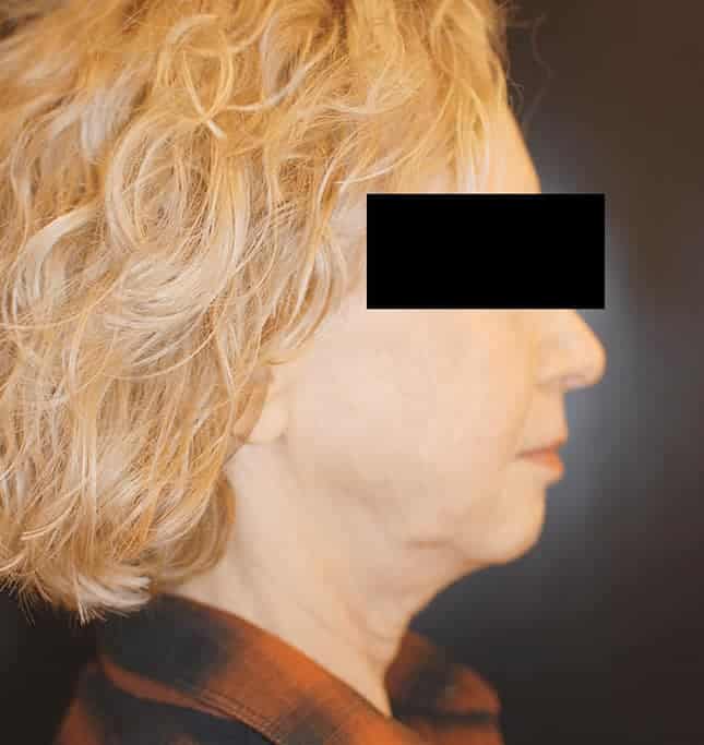 Before Image: Facelift - right-side