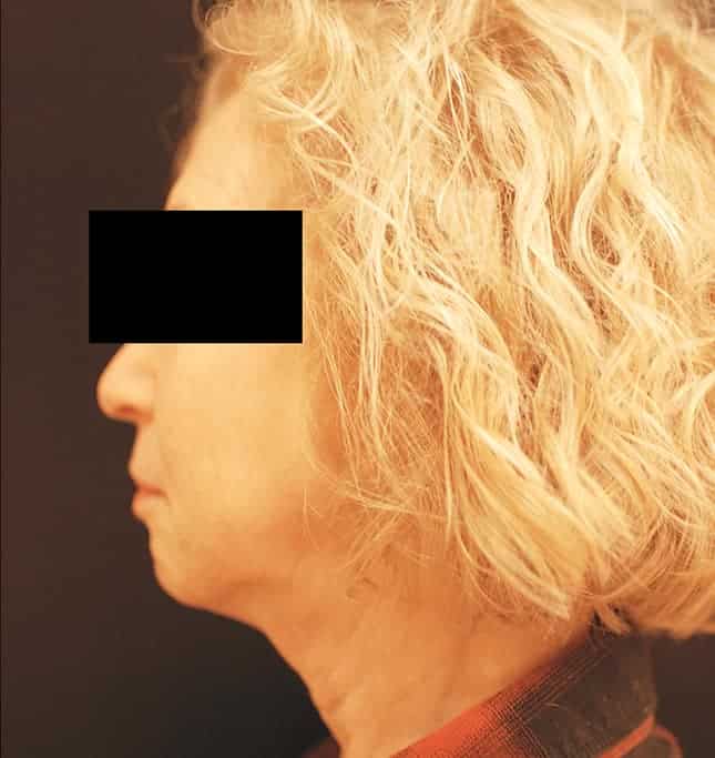 Before Image: Facelift - left-side