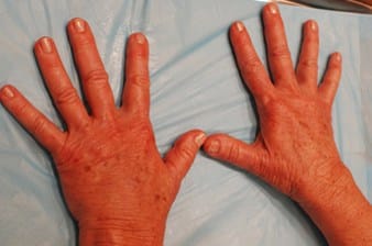 After Image: PRFM Gel Hand Treatment - front