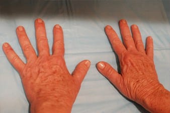Before Image: PRFM Gel Hand Treatment - front
