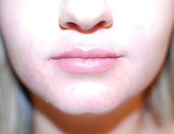 After Image: Lip Filler with RHA2 Revance Therapeutics - front