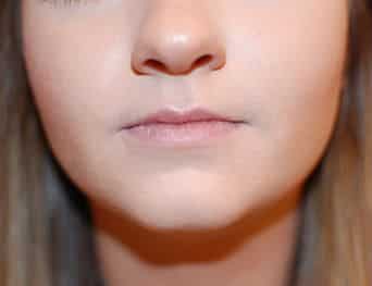 Before Image: Lip Filler with RHA2 Revance Therapeutics - front