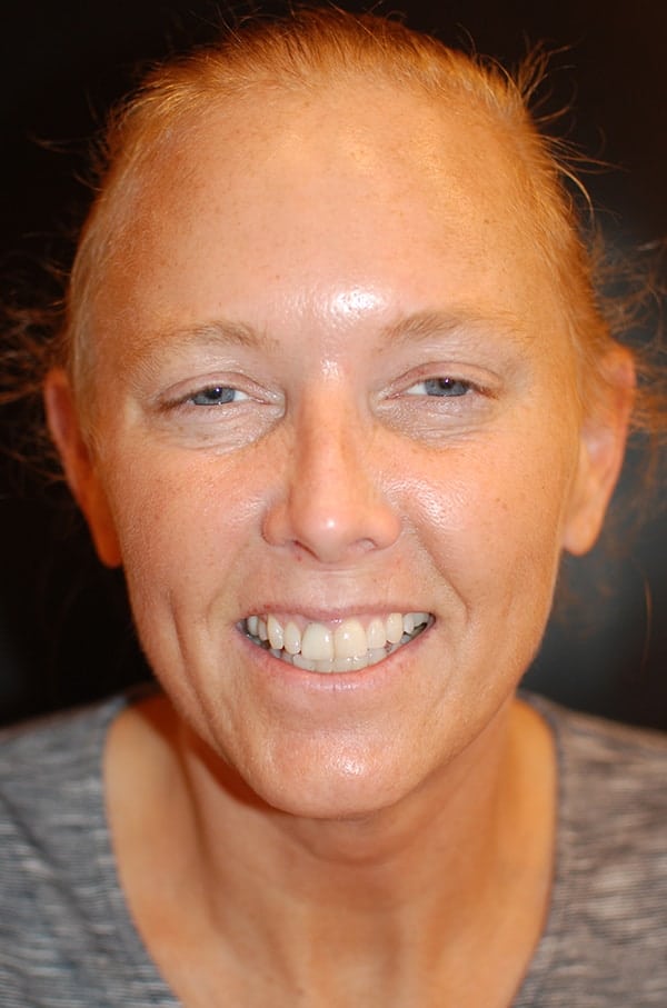After Image: Dysport to Glabella & Forehead - front
