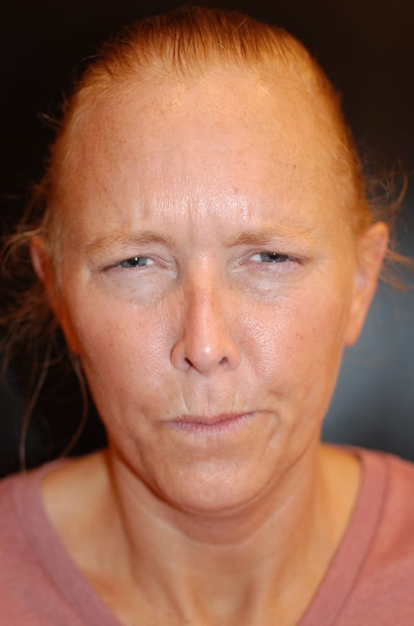 Before Image: Dysport to Glabella & Forehead - front