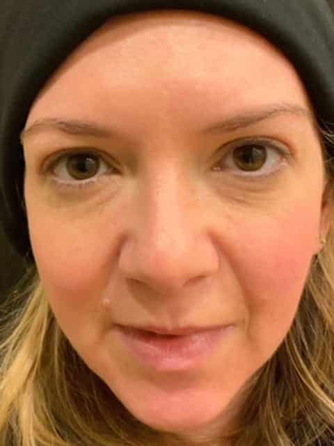 After Image: Under Eye Filler with RHA2 Revance Therapeutics - front