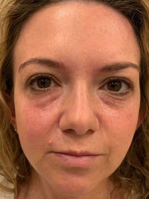 Before Image: Under Eye Filler with RHA2 Revance Therapeutics - front