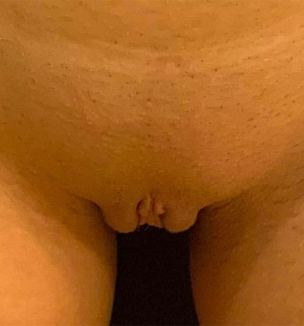 After Image: Labiaplasty - front