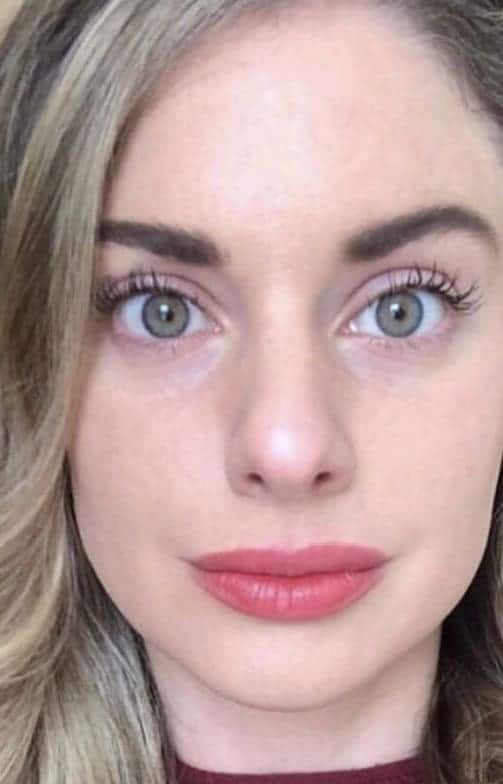 After Image: Laser Resurfacing - front