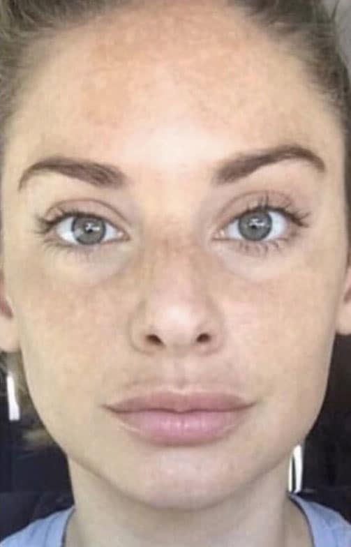 Before Image: Laser Resurfacing - front