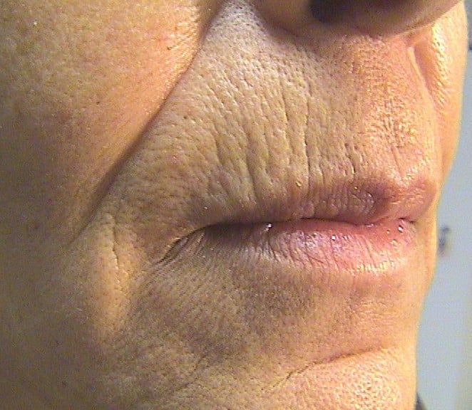 Before Image: Laser Resurfacing - right-front-oblique