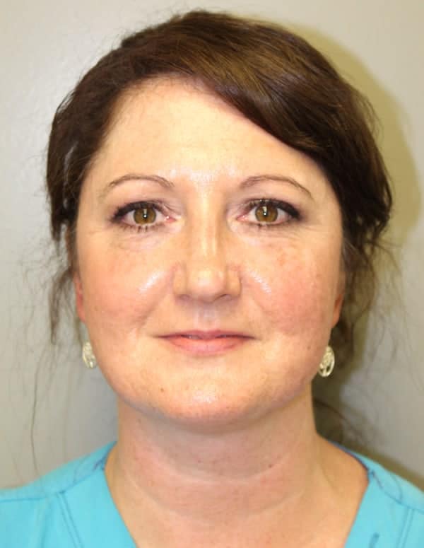After Image: Laser Resurfacing - front