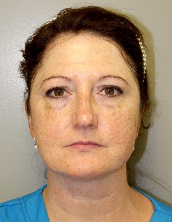Before Image: Laser Resurfacing - front
