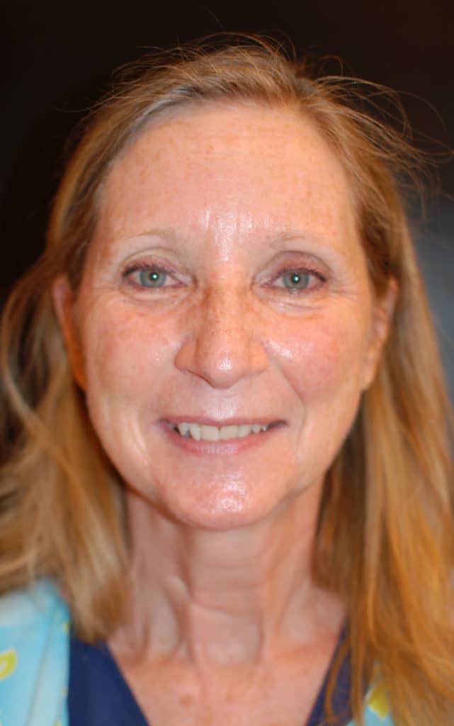 After Image: Laser Resurfacing - front