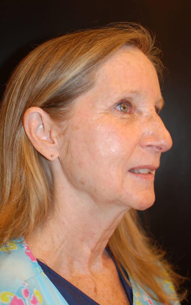 After Image: Laser Resurfacing - right-side