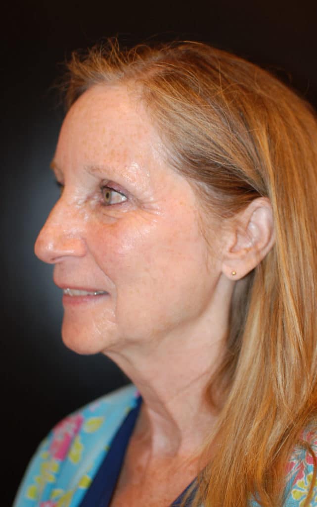 After Image: Laser Resurfacing - left-side