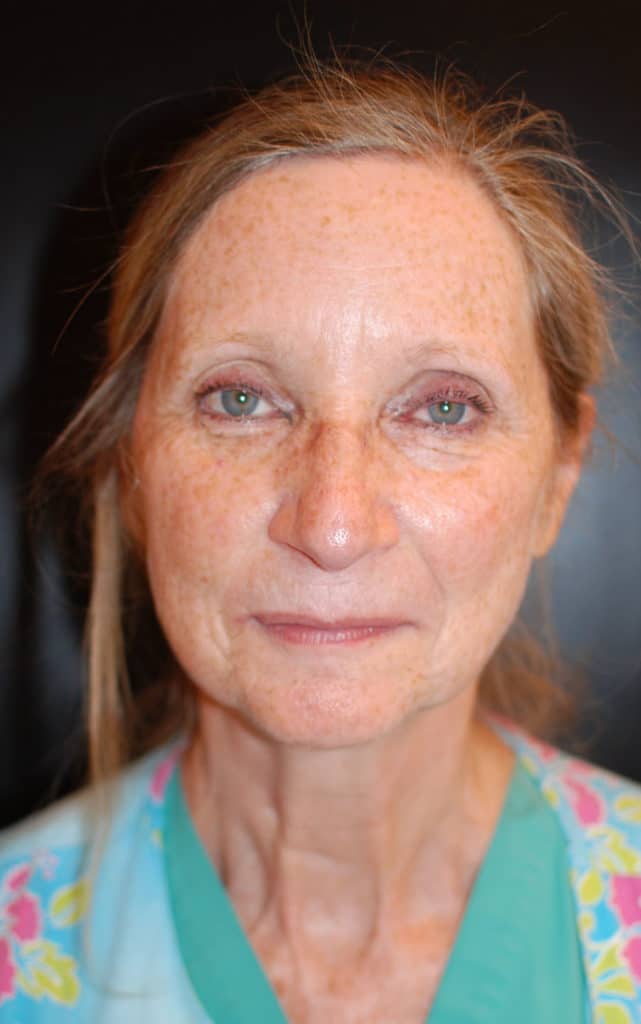 Before Image: Laser Resurfacing - front