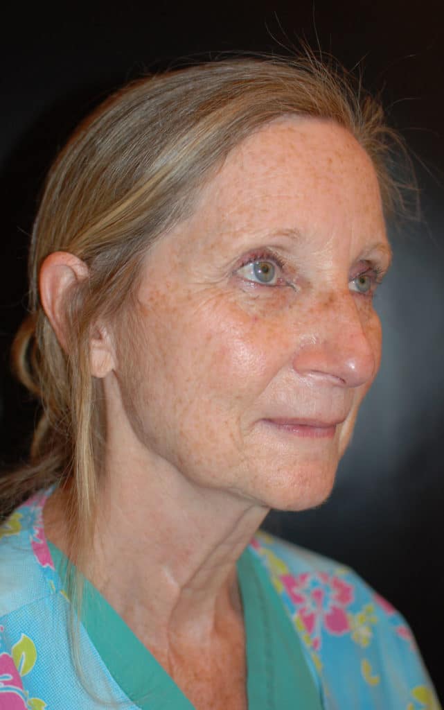 Before Image: Laser Resurfacing - right-side