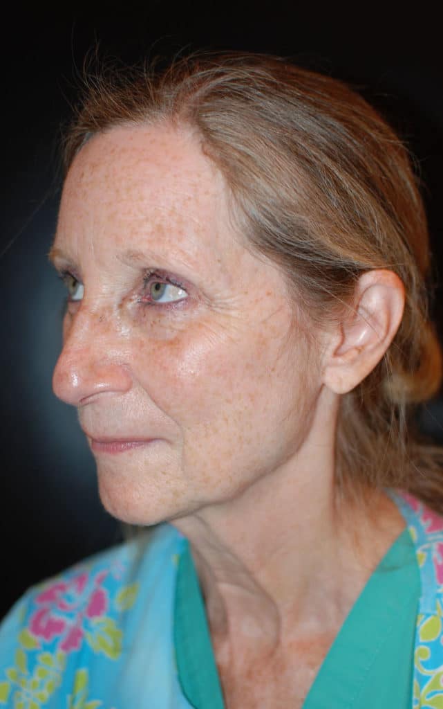 Before Image: Laser Resurfacing - left-side