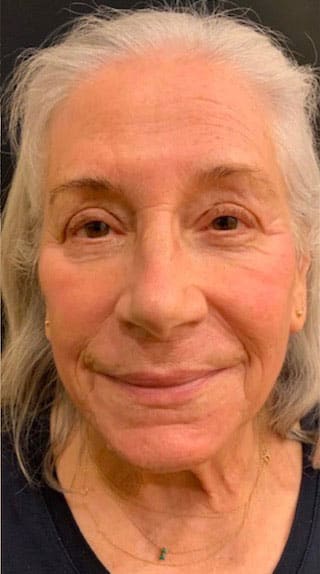 After Image: Laser Resurfacing - front