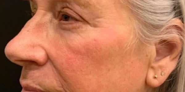 After Image: Laser Resurfacing - left-side