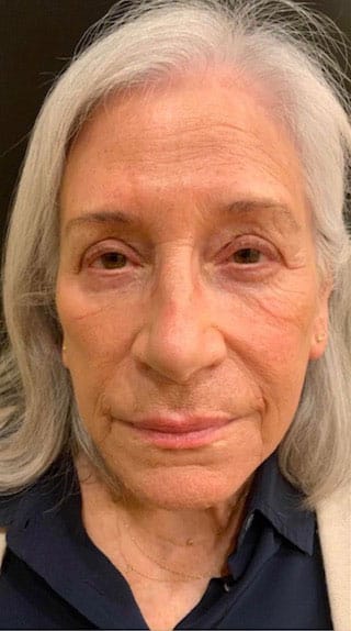 Before Image: Laser Resurfacing - front
