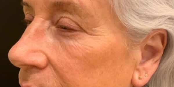 Before Image: Laser Resurfacing - left-side
