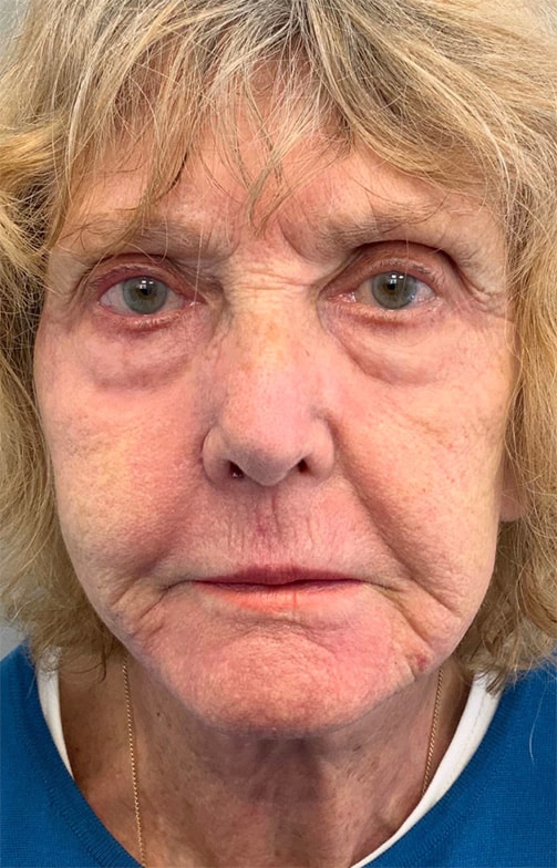 After Image: Laser Resurfacing - front