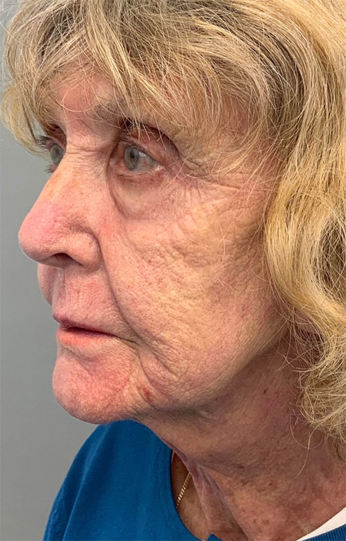After Image: Laser Resurfacing - left-front-oblique