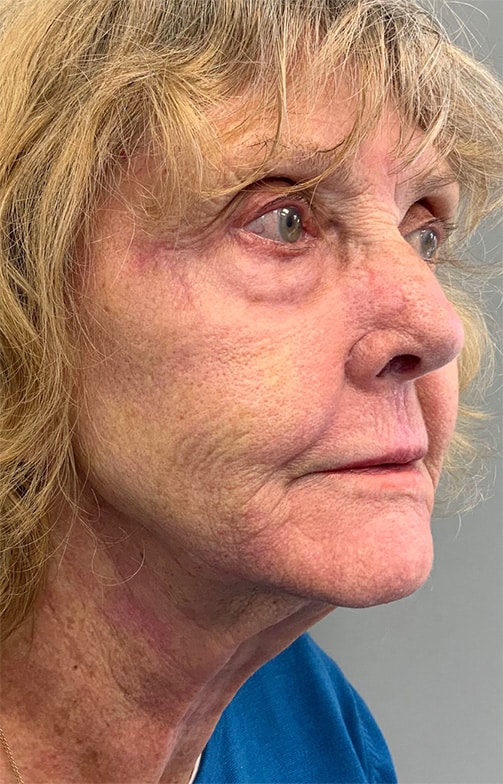 After Image: Laser Resurfacing - right-front-oblique