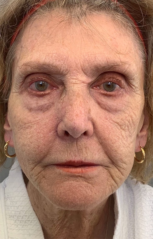 Before Image: Laser Resurfacing - front